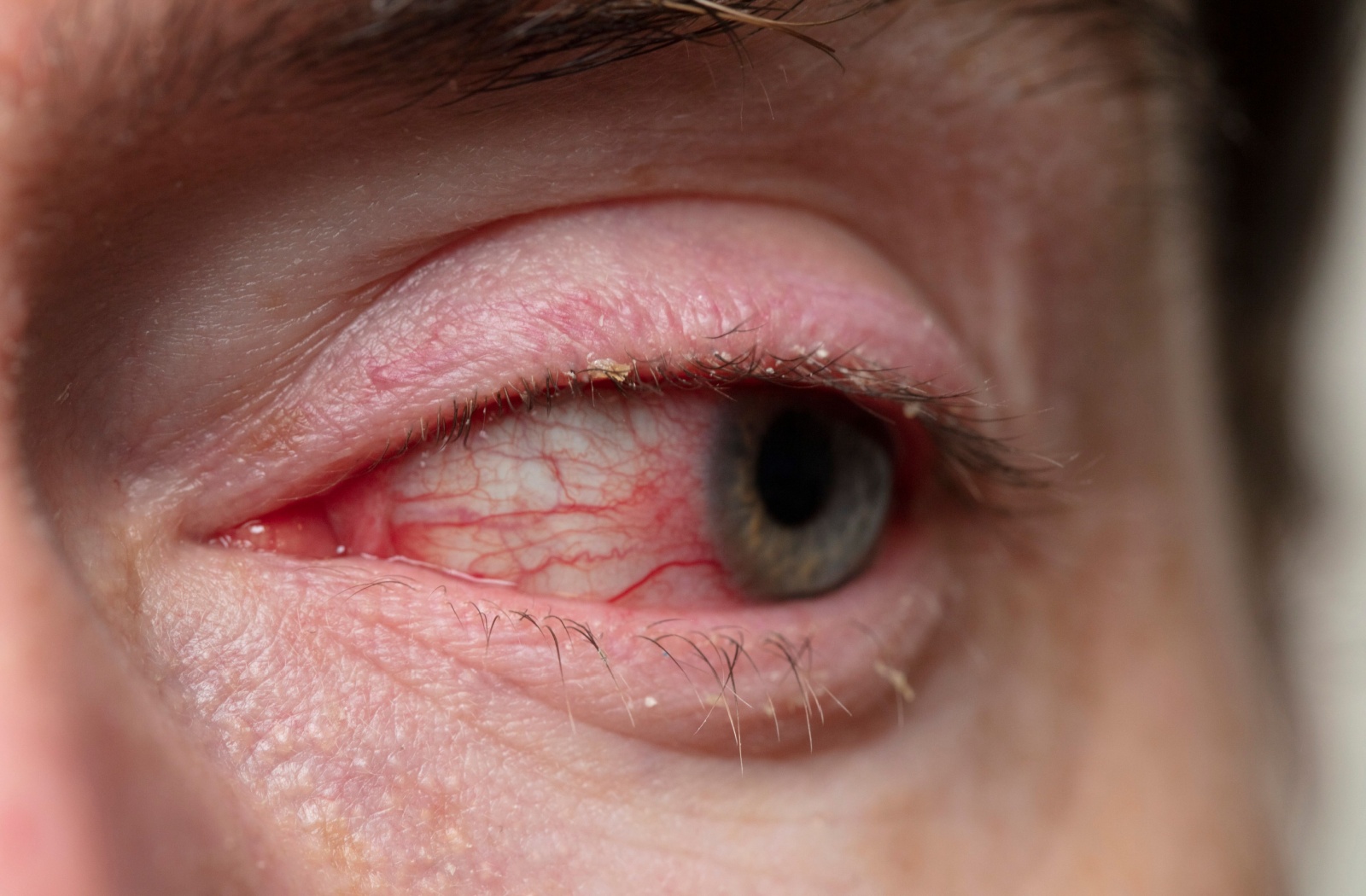 Is Blepharitis Contagious? | First Optometry | St. Thomas